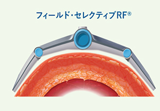 フィールド・セレクティブRF™