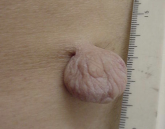 懸垂性線維腫